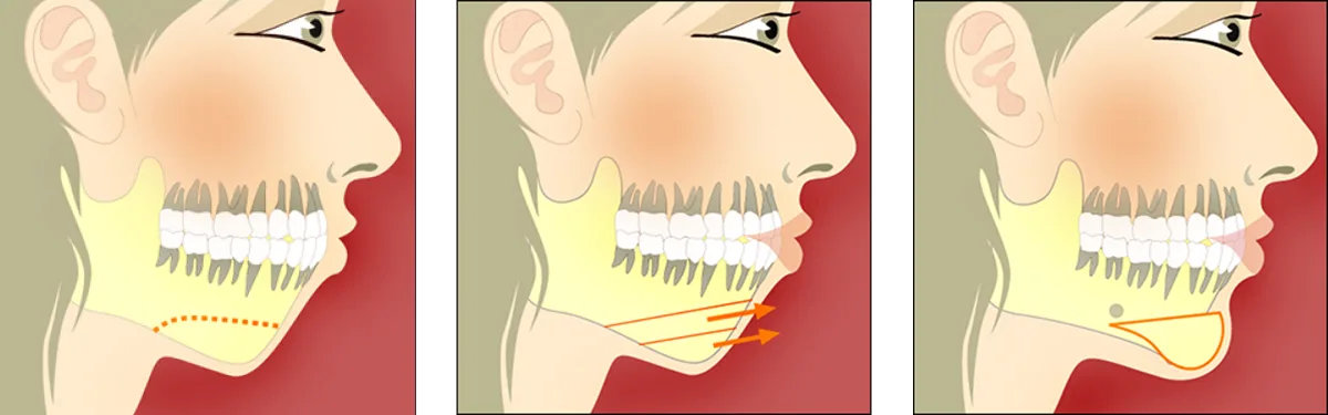 Pre-surgical cephalometric chin projection evaluation