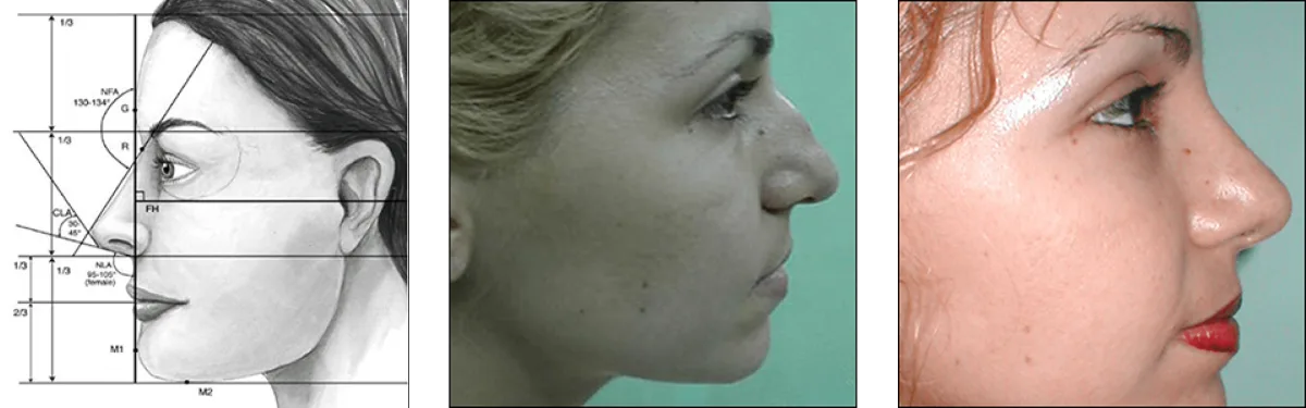 Anatomical diagram of nasal dorsum, cartilage, and bone structure for rhinoplasty