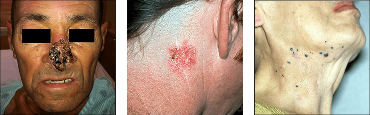 Clinical assessment of atypical facial cutaneous lesion borders